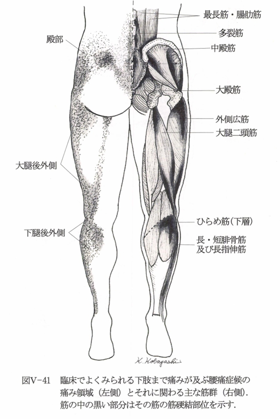 腰・下肢の筋硬結の図