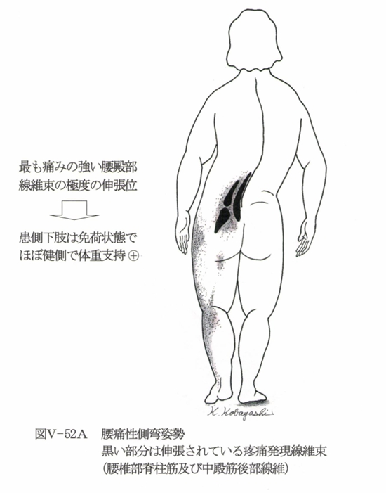 疼痛緩和肢位の図