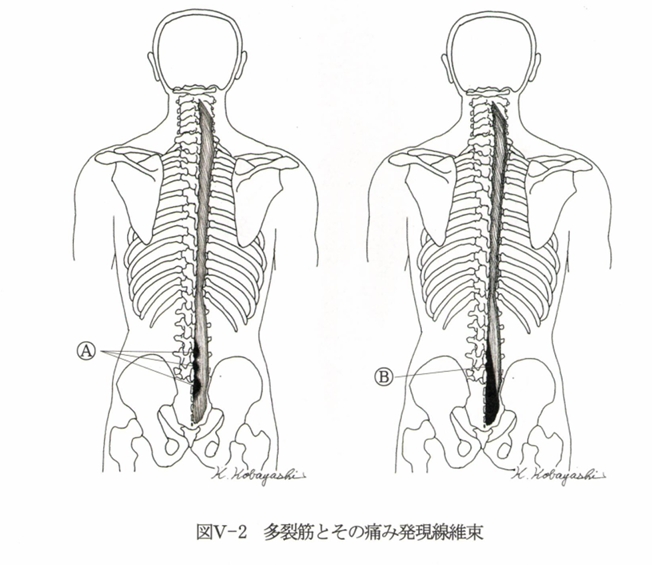 腰部多裂筋の筋硬結の図