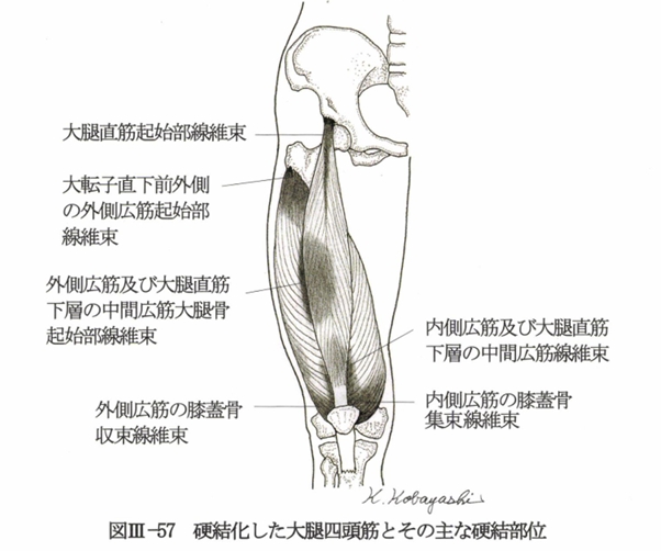 大腿四頭筋の硬結