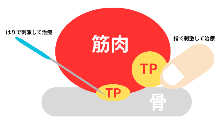トリガーポイントの治療イメージ図