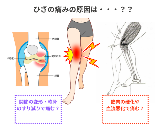 ひざの痛みの原因の図