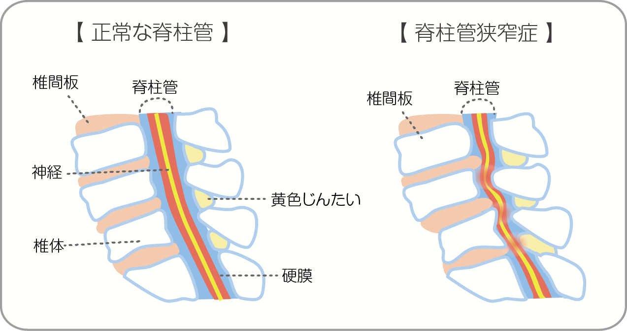 腰部脊柱管狭窄症の図