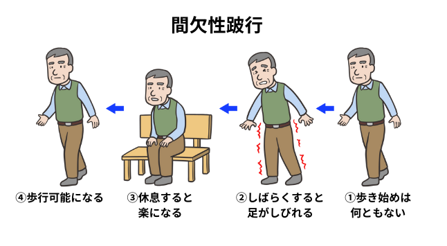 神経性間欠性跛行の図