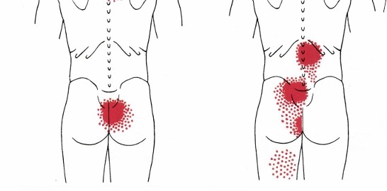 多裂筋の関連痛