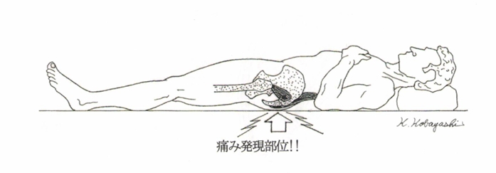 背臥位臥床時の腰痛の図