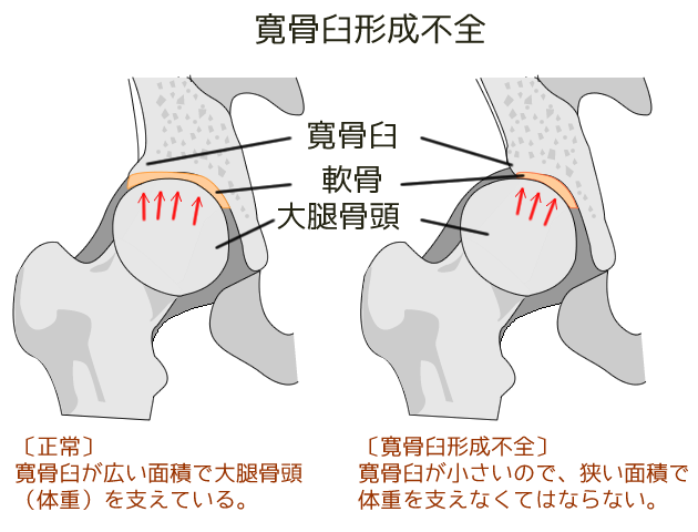 臼蓋形成不全を説明したイラスト