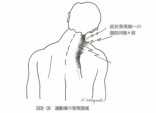 頸椎側屈時の関連痛