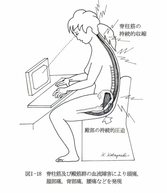 デスクワークによる筋性疼痛