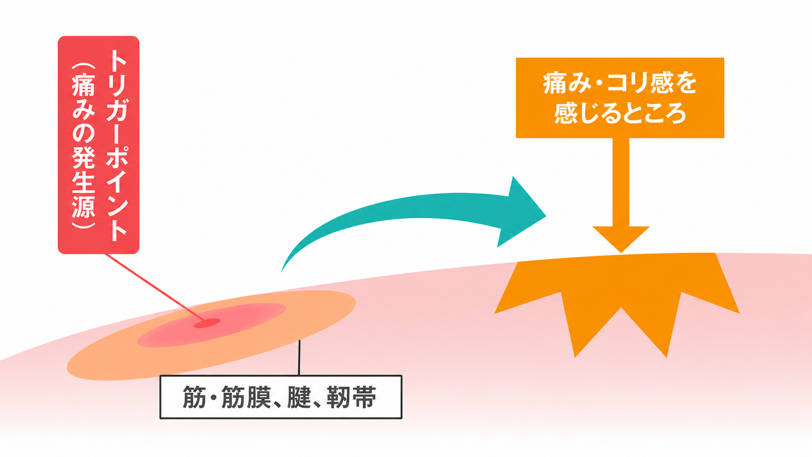 トリガーポイントと自覚する症状が離れた部位に感じる図解