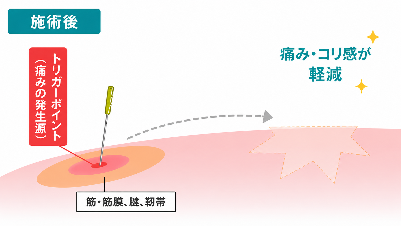 トリガーポイント鍼療法の効果を示す図解