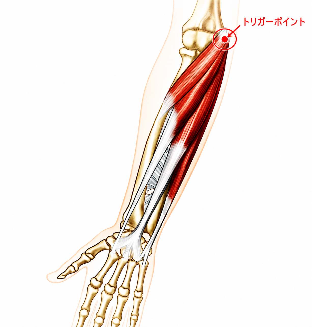 肘内側の痛みに関わるトリガーポイントを示した解剖図
