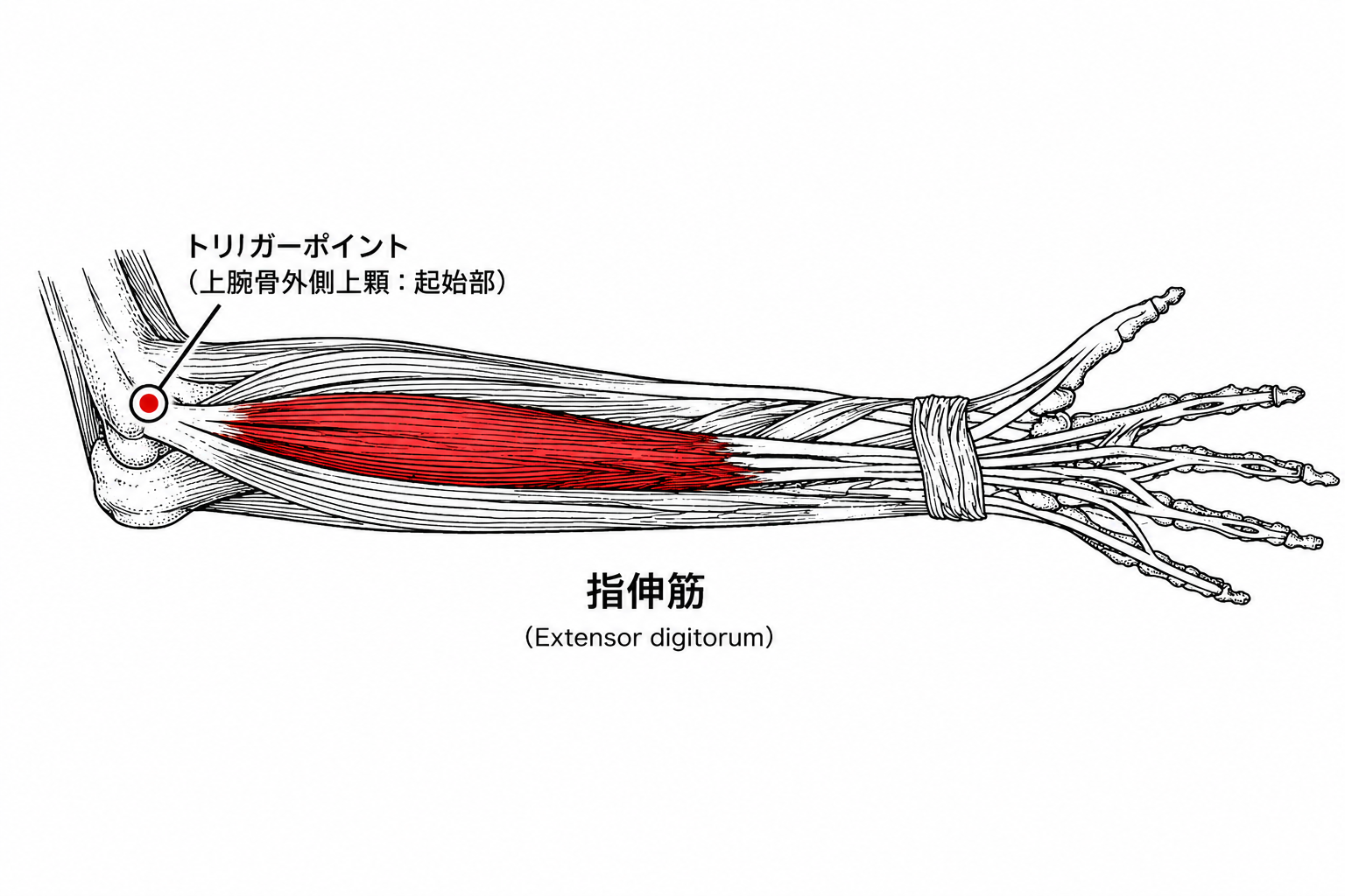 テニス肘にみられる指伸筋のトリガーポイントの解剖図
