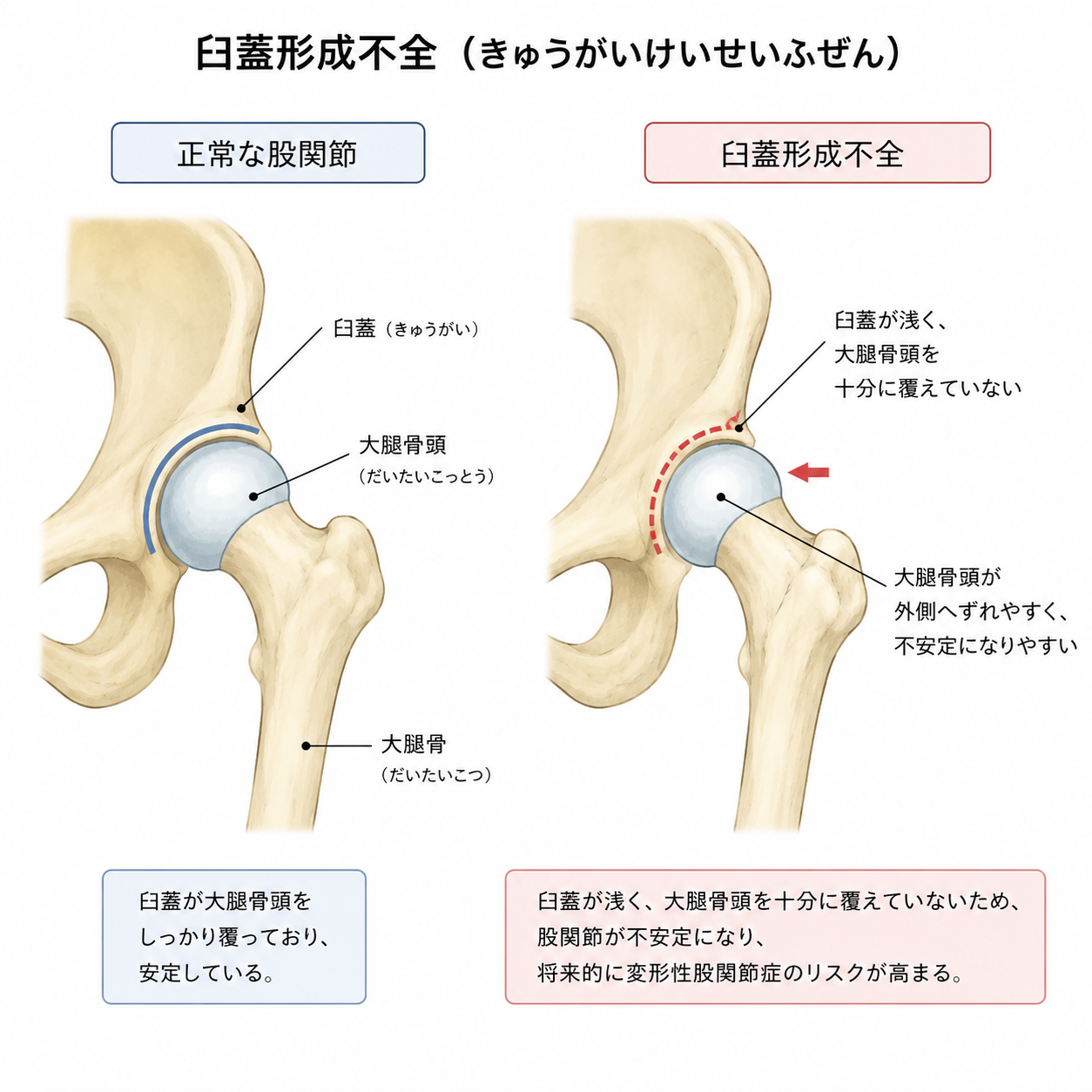臼蓋形成不全を説明したイラスト