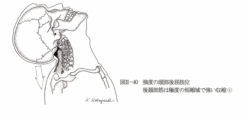 頸椎の伸展時の痛み発現機転