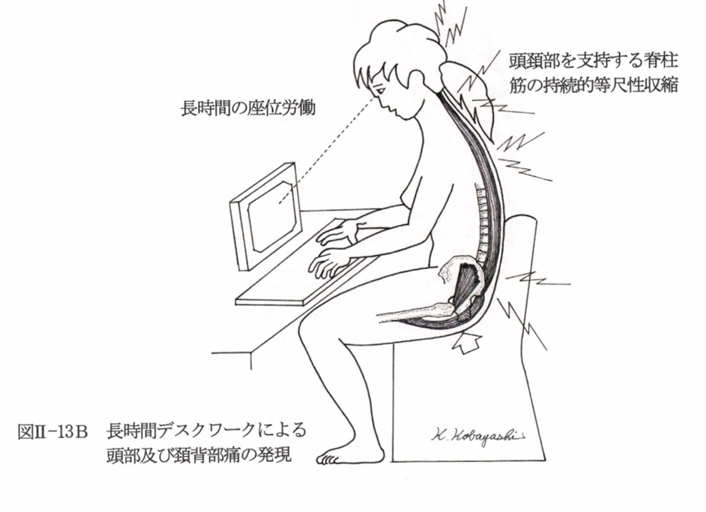 座位姿勢での筋性疼痛