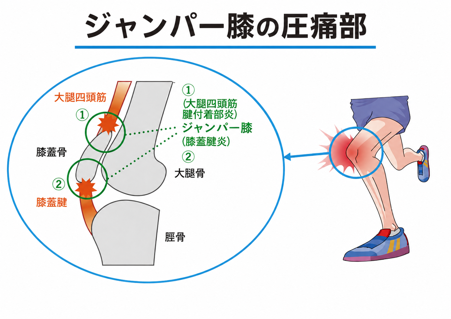 ジャンパー膝の圧痛部